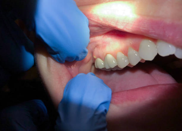Best Dentist for Tooth Abscess  in Safety Harbor, FL